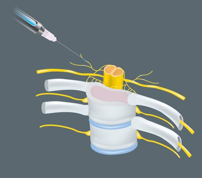 neurologicalconditionsnerveblock